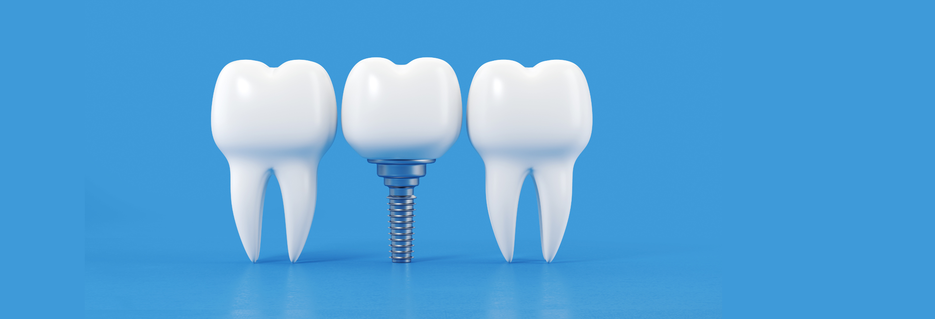 Cấy ghép Implant